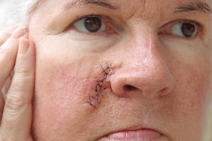 An,Older,Woman,Has,A,Surgical,Scar,On,Her,Face